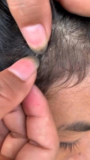54K views · 245 reactions | #satisfying #AsmrLice #Lice #piojos #KUTO #RemovalLice #poux #KutuRambut #HairTreatment #asmrsound #LiceVirals | Irawati Muskin | Facebook
