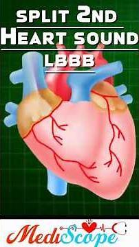 Split 2nd Heart sound with Lt Bundle Branch Block