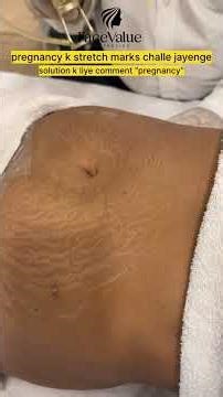 Pregnancy Stretch Mark Treatment