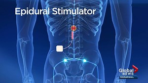 Health Matters: Ground-breaking discovery in spinal cord injury research