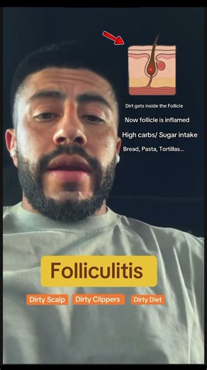 After a haircut skin rash from Barber + what is it? #ytshort #short #drewz #barbershop #folliculitis
