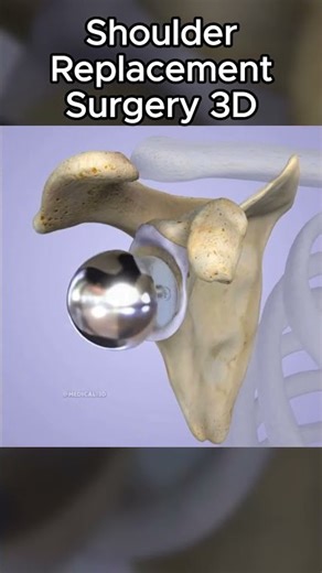 Shoulder Replacement Surgery 3D
