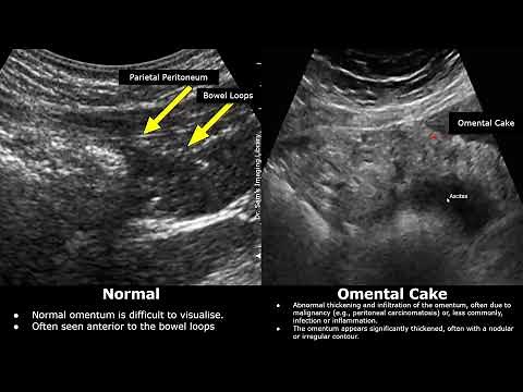 Omentum Ultrasound Normal Vs Abnormal Images | Omental Cake, Nodularity, Metastases, Infarction USG