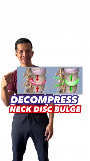Effective way to decompress your cervical disc bulge! - Disclaimer: The following information is provided for general educational purposes only and should not be construed as medical advice or a substitute for professional medical guidance, diagnosis, or treatment. It is imperative to seek professional advice and supervision before attempting cervical traction to ensure your safety, well-being, and optimal health outcomes. #cervicaltraction #traction #discbulge #bulgingdisc #discherniation #hern