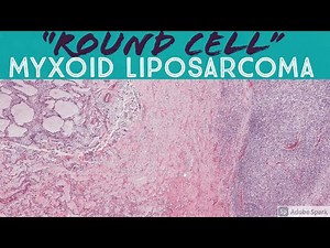 "Round cell" High Grade Myxoid Liposarcoma