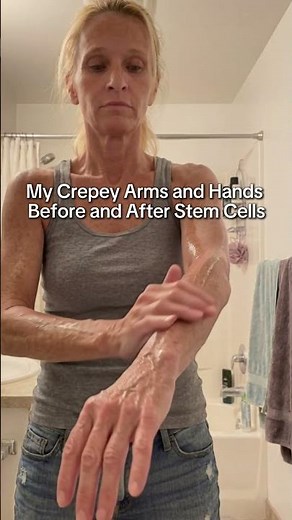 My Crepey Arms and Hands Before and After Stem Cells 🤯