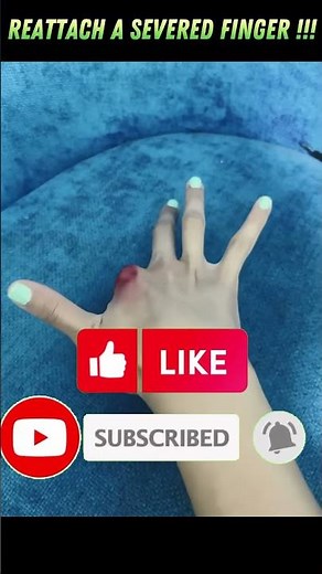 How to Save a Severed Finger – Life-Saving First Aid Tips