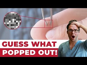 How to Remove Splinters from Feet