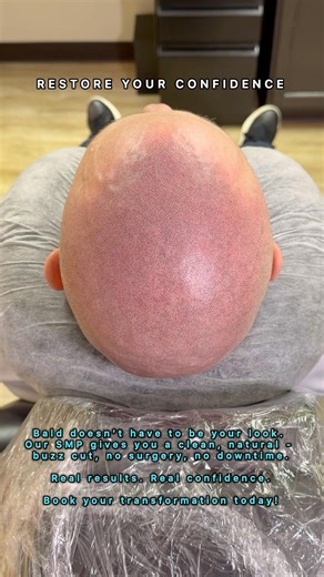 AMAZING SCALP MICROPIGMENTATION! ADJUST VIDEO TO 720P FOR HI-QUALITY RESOLUTION ​⁠@supremesmp2047