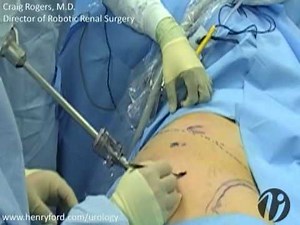 Robotic Partial Nephrectomy - Step 2: Port Templates and Trocar Placement • Video • MEDtube.net
