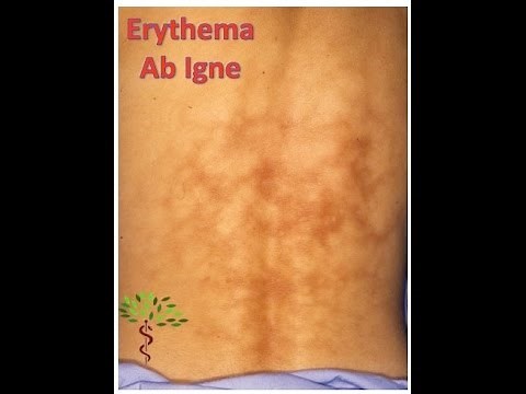 Erythema Ab Igne