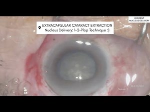 Extracapsular Cataract Extraction Nucleus Delivery: 1–2–plop technique