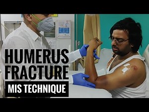 Fracture Humerus fixation by MIS Technique -- Part 1