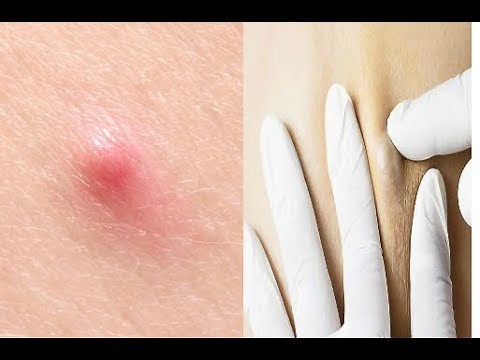 How can you tell if the bump under your skin is harmless or something more serious