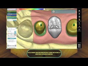 [EXOCAD] Piliers + bridge Transvissé