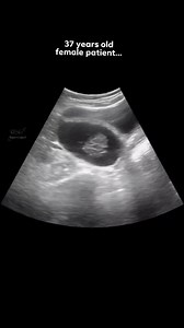 #ultrasound #ovary #uterus | Ultrasound report expert