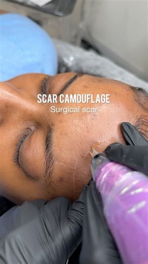D’Lux Artistry | Cosmestics & Permanent Makeup Studio | Scar camouflage on a facial surgery scar. Now offering virtual training and guided model days. To schedule your training please call or... | Instagram