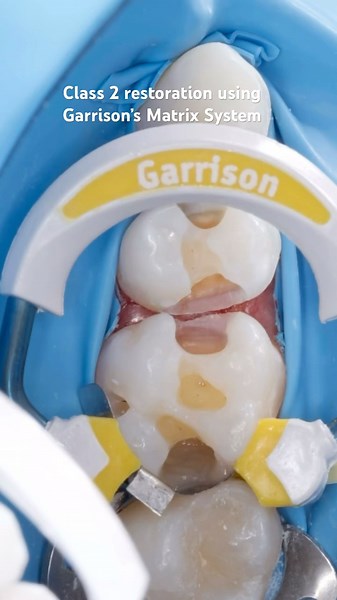 To purchase our new sectional matrix system, click the link in bio 🔗