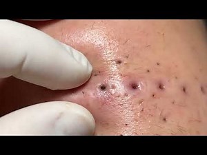 🤯Blackhead EXPLOSION! #26 You WON'T Believe This Trick! 😱👃