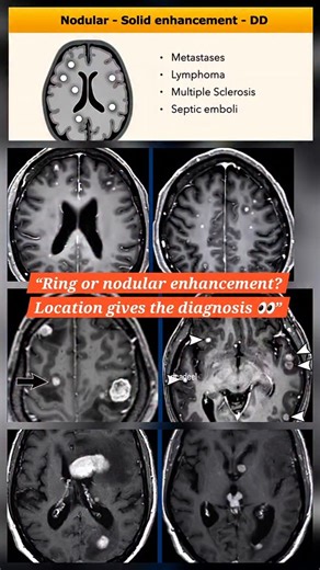 Nodular Brain Lesions Explained | Metastases, Lymphoma, MS & More Multiple nodular enhancing lesions in the brain can look similar — but the diagnosis depends on pattern and location. In this reel, we break down the nodular enhancement pattern and show how to differentiate: • Metastases • Primary CNS lymphoma • Bing–Neel syndrome • Septic emboli • Multiple sclerosis 📍 Gray–white matter junction 📍 Watershed areas 📍 Periventricular and corpus callosum involvement Understanding these imaging clu