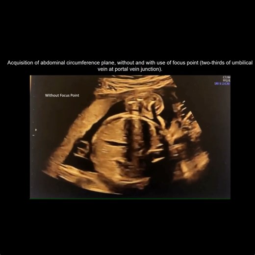 Read new open-access #UOGJournal article showing that using a focus-point method to obtain planes for fetal biometry improves measurement reproducibility, independently of operator expertise, plane acquired and structure visualized https://bit.ly/42JDXCK | International Society of Ultrasound in Obstetrics and Gynecology (ISUOG)