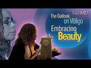 Embracing Beauty: Living with Vitiligo | WebMD