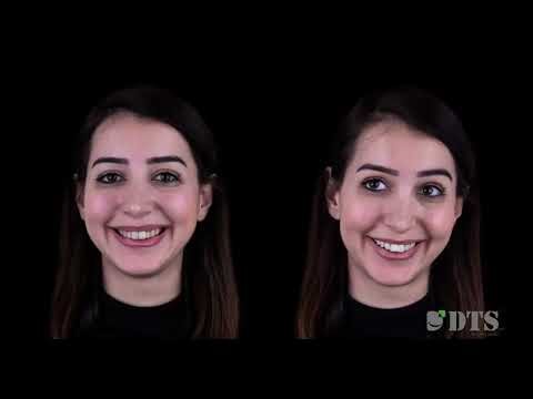 DTS Pro Instant Smiles Video Simulation