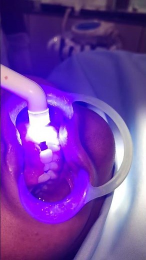 Dental braces procedure