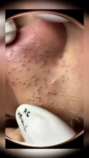 pimple popping satisfying (146)