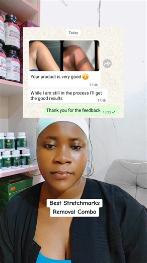 Best Solutions for Stretch Marks Removal