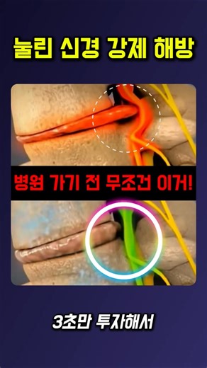 눌린 신경 강제 해방 #허리통증 #디스크스트레칭