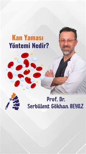 🩸 Omurgaya kan verdiğimiz bir tedavi yöntemi var! Bazı durumlarda omurga zarları içinde bulunan beyin-omurilik sıvısının basıncı değiştiğinde hastalarda 💥 şiddetli baş ağrısı 💥 bel ağrısı 💥 ayağa kalkınca artan ağrı gibi şikayetler ortaya çıkabilir. Bu tür durumlarda uyguladığımız yöntemlerden biri: 🔬 Epidural Kan Yaması (Epidural Blood Patch) Bu işlemde hastadan alınan kendi kanı, steril koşullarda 🦴 omurga çevresindeki epidural alana enjekte edilir. Amaç: ✔️ Omurga zarındaki kaçak bölges