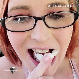 3.4K views · 29 reactions | This client's results are truly incredible! Learn more at brighterimagelab.com | Press On Veneers by Brighter Image Lab | Facebook