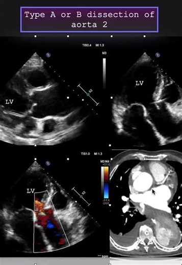 Type A or B dissection of aorta 2