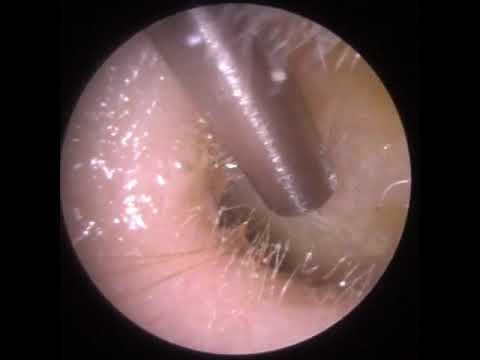 798 - Severely Impacted Bilateral Ear Wax Removal