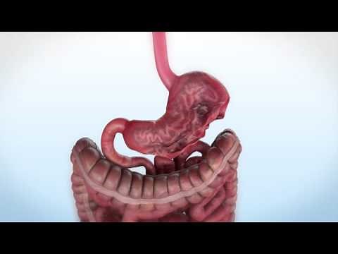 Apollo OverStitch - Endoscopic Sleeve Gastroplasty