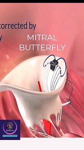 77K views · 515 reactions | Mitral Valve Regurgitation - Corrected by Mitral Butterfly #mitralvalve #reelsvideoシ #foryouシ #medical #a#animation | Medical Animation Media | Facebook