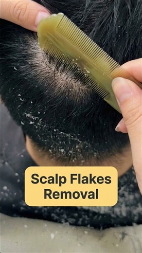 You won't believe how much dandruff this comb removed 😱 #dandruffremoval #satisfying #asmr
