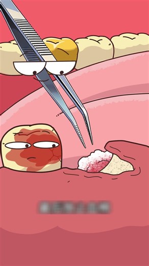 Horizontal Wisdom Tooth — How Do You Remove It #animation #funny #cartoon #facts #memes #3danimation
