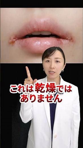 【これは乾燥ではありません】口角のトラブルを皮膚科医が解説