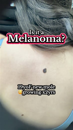 Dr. Mathieu Powell, MD | Is it a melanoma? Does it need a biopsy? 🧐 🤓 Answer: YES a biopsy is warranted here. There are several atypical features including... | Instagram