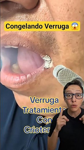 Congelando Verruga 😱#medicina #medico #enfermagem #enfermeiro #enfermeira #dermatologia HPV
