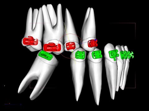 Uprighting molars with the Straight wire system part 1