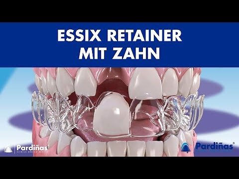 ESSIX RETAINER mit Zahn – Provisorische Lösung für Zahnersatz ©