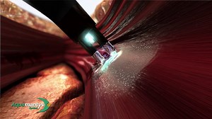 Salient Surgical Technologies Aquamantys Animation