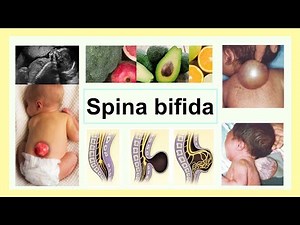 spina bifida