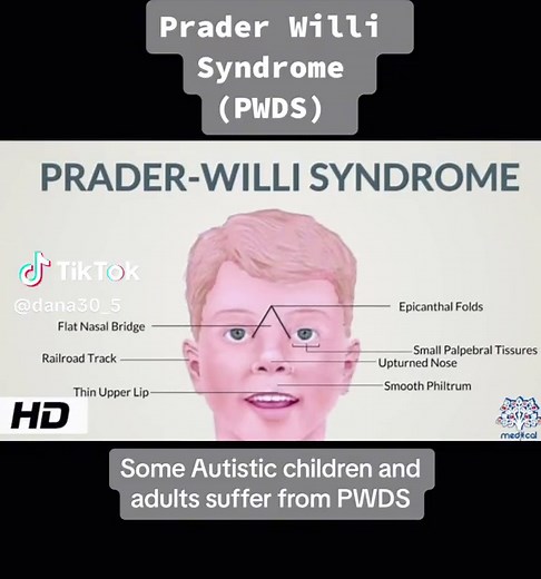 #foryou #video #autismawareness #pwds #autismacceptance #awareness #clip #fy #genetic #specialneedsmom #autism