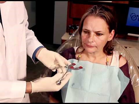 Facebow Procedures by Panadent