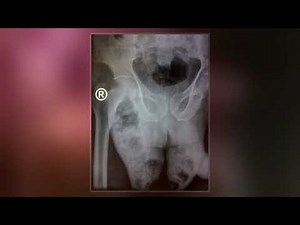 Fournier Gangrene