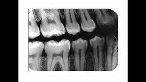 Basics of Dental X-Rays Review